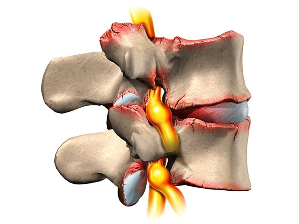 lesione spinale con osteocondrosi