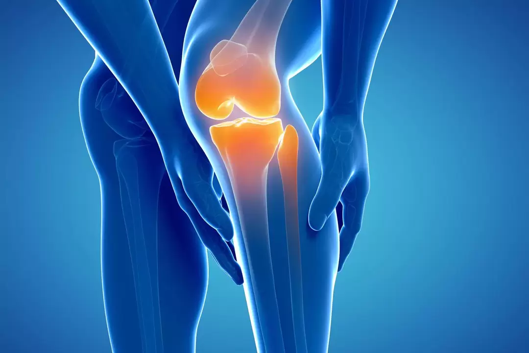 Artrosi dell'articolazione del ginocchio (gonartrosi, osteoartrite deformante)