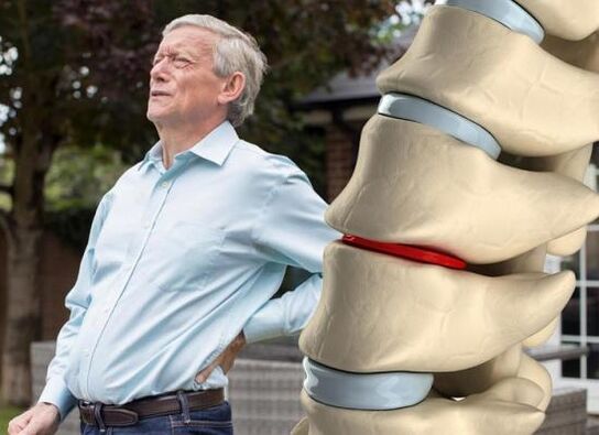 L'osteocondrosi colpisce i dischi intervertebrali e provoca mal di schiena